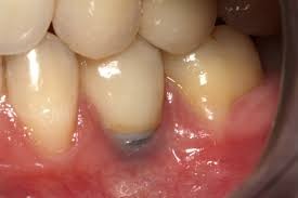 periimplamtitis